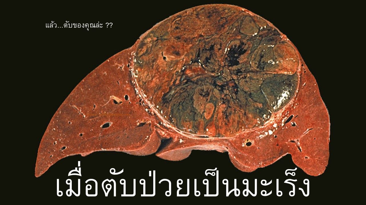 มะเร็งตับ